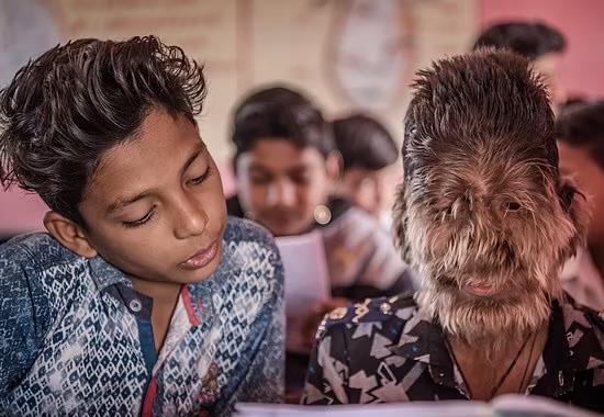 Werewolf Syndrome,  Hypertrichosis,  Hypertrichosis Werewolf Syndrome, Madhya Pradesh Werewolf, Madhya Pradesh Lalit Werewolf Syndrome, India News, India News Today, India News Live, India Live Updates- True Scoop